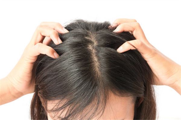 女的梦见头上全是大块头皮屑